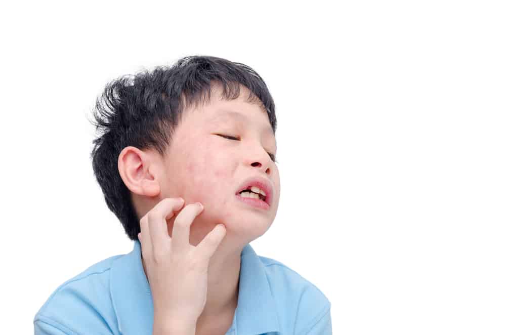 Non prendetela alla leggera, parotite nei bambini: questi i sintomi, le cause e come affrontarla