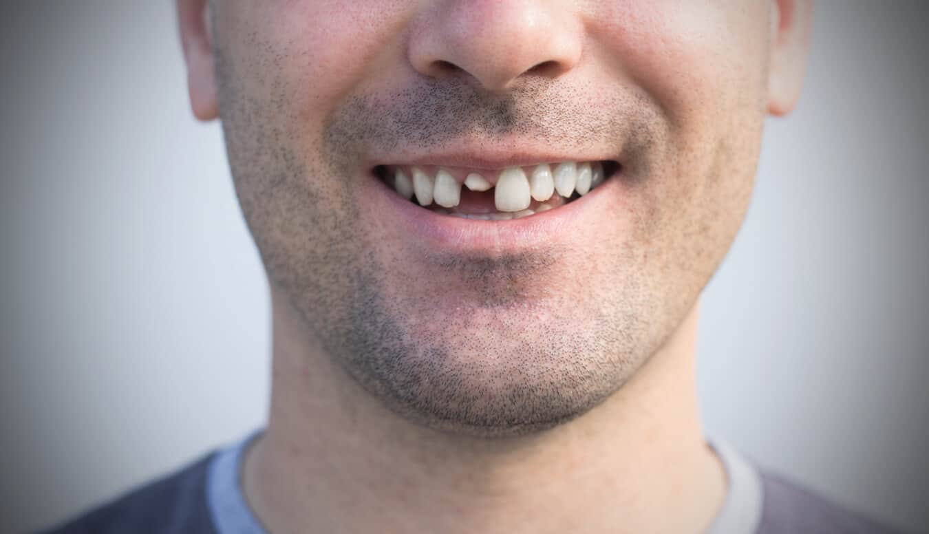 هل يمكن للأسنان المكسورة أن تنمو مرة أخرى؟ ها هو التفسير!