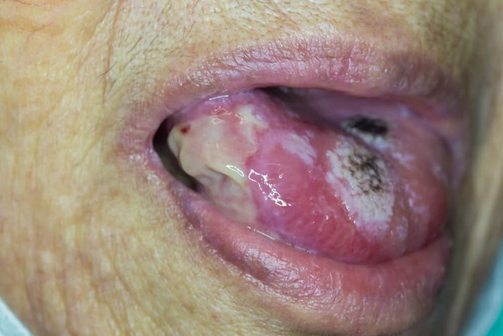 軽く服用しないでください、潰瘍の痛みは舌がんの兆候である可能性があります