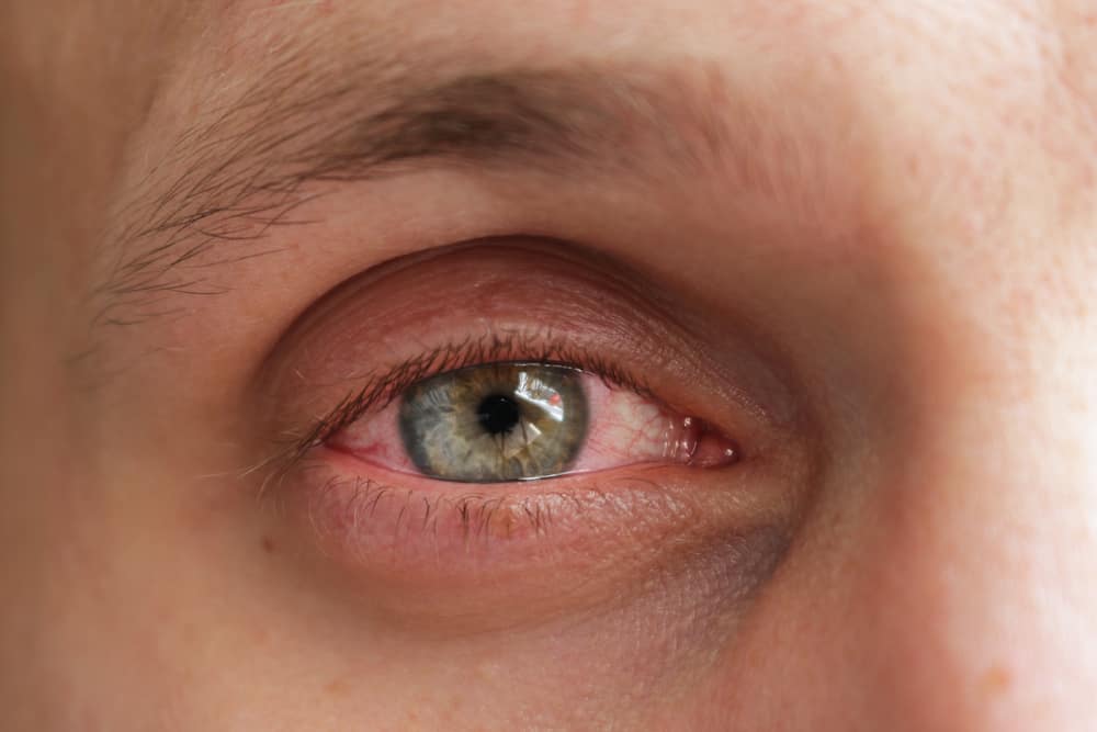 يجب ان يعرف! هذه هي الأسباب المختلفة للعيون الحمراء والمائية السهلة