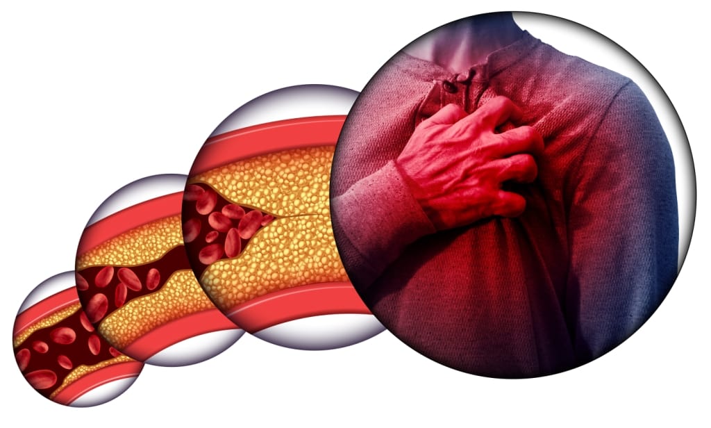 Penyakit Aterosklerosis: Ketahui Gejala, Sebab, dan Rawatan