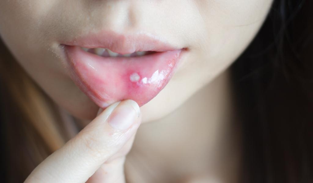 خصائص فيروس نقص المناعة: جفاف الفم للبثور!