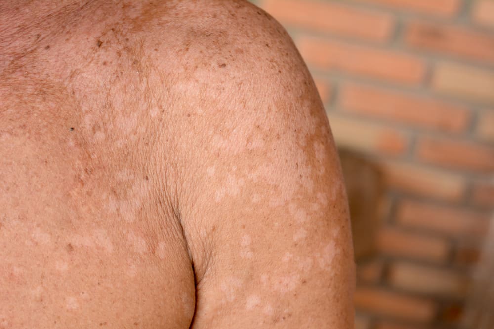 Причини за появата на Пану върху кожата и как да го предотвратим