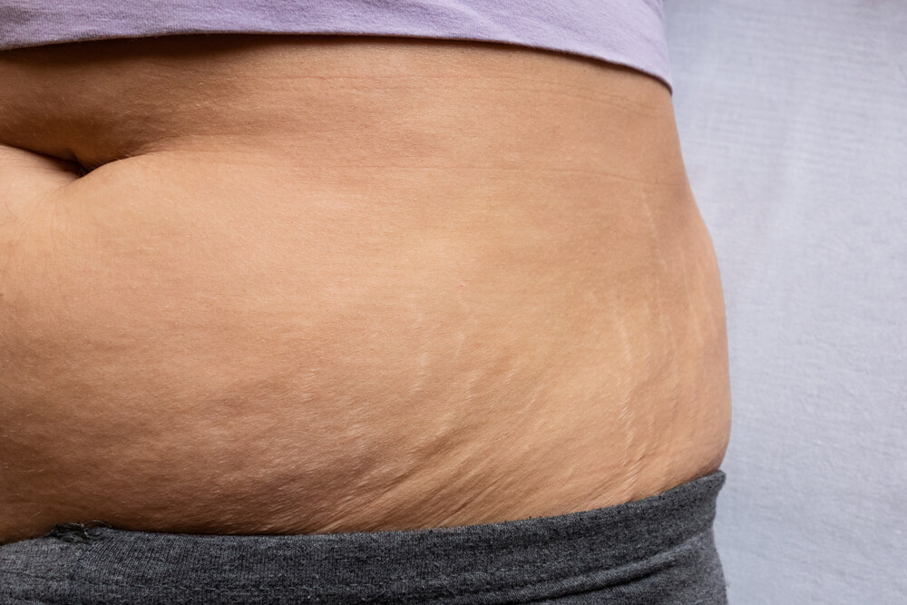 نصائح قوية لشد الجلد المترهل بسبب فقدان الوزن