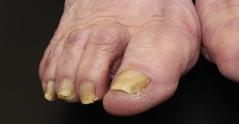 さじ状爪を認識し、爪の病気は体の鉄欠乏に署名します