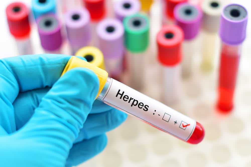 5 Jenis Ubat Herpes Zoster untuk Cacar, Inilah Senarai!