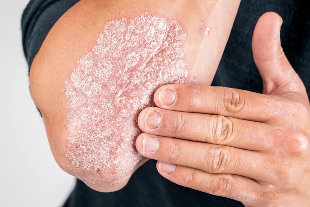 7 malattie della pelle spesso colpite dagli indonesiani, quale hai sperimentato?