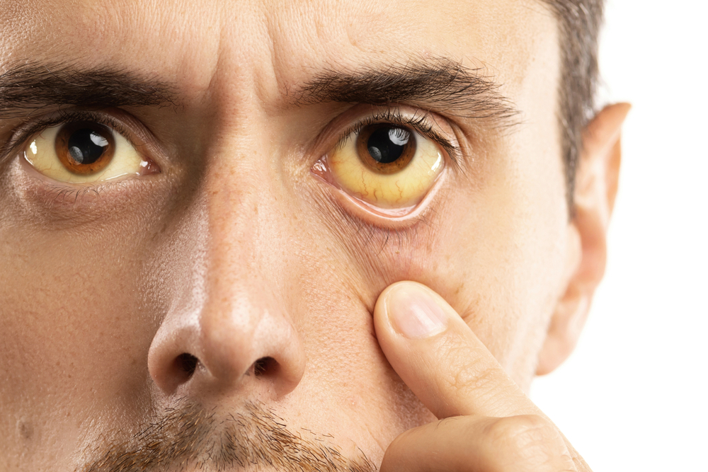 Cause degli occhi gialli: dai problemi alla leva alla cistifellea