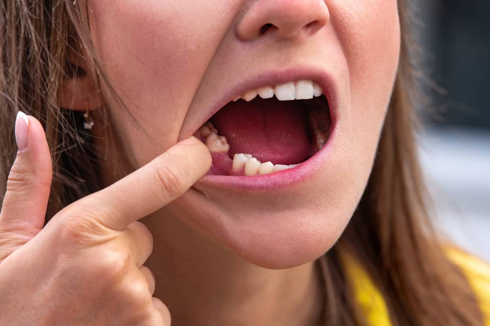Pelbagai Cara Mendapatkan Gigi Yang Goyang Untuk Turun Secara Semula Jadi
