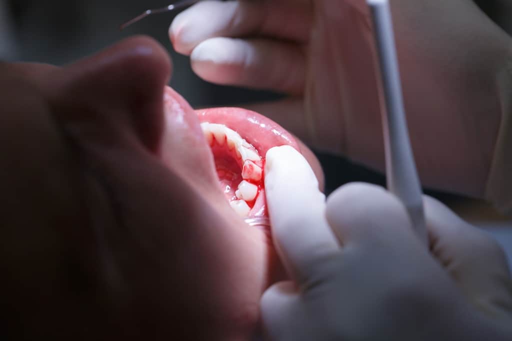 歯茎の出血、白血病に対する歯肉炎の6つの原因