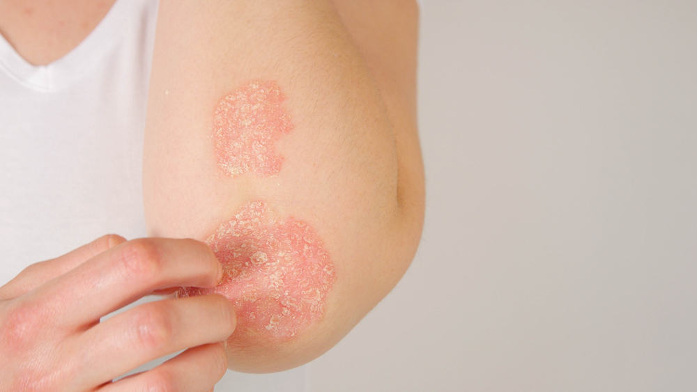Увреждане на имунната система, хайде, разпознайте симптомите на кожно автоимунно заболяване на кожата