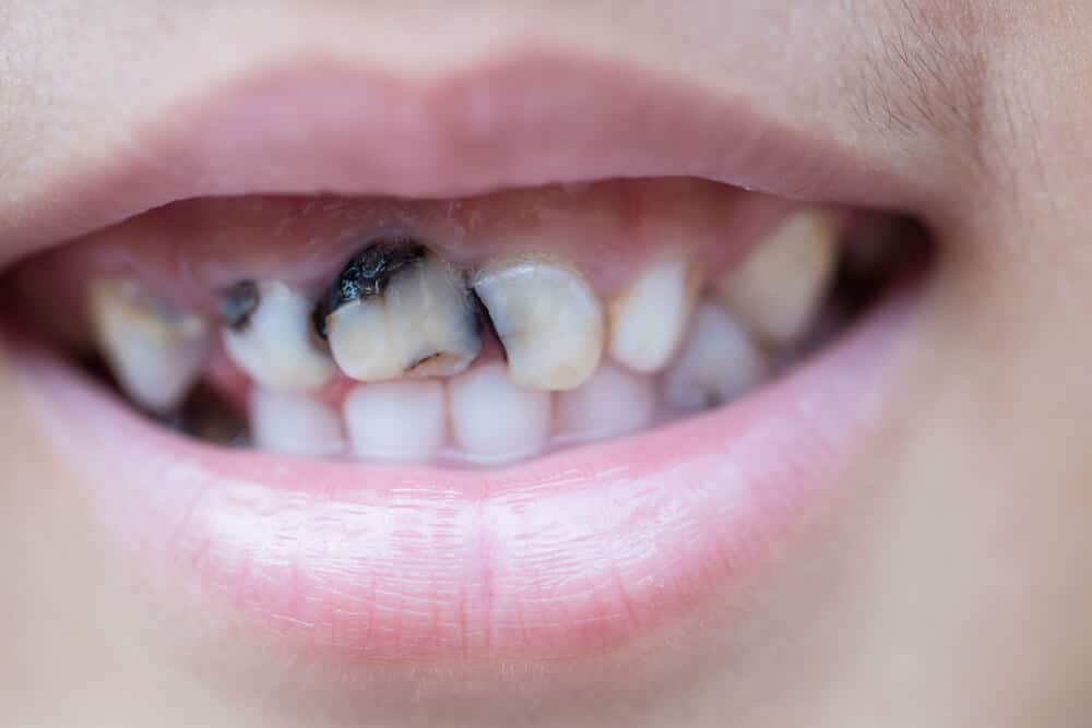 Faktor penyebab gigi hitam dan cara yang betul untuk menghilangkannya