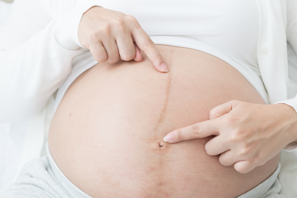 Garis-garis Hitam pada Perut Semasa Kehamilan Membuat Anda Tidak Selesa? Inilah penjelasannya!