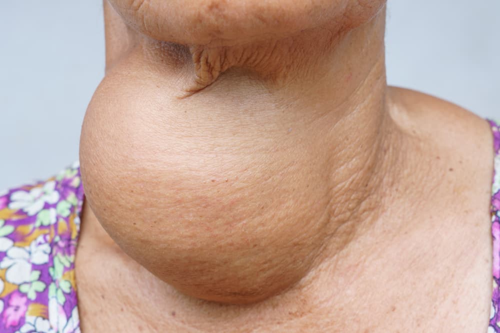 Malattia della parotite: attenzione quando la ghiandola tiroidea cresce Ingrandisci