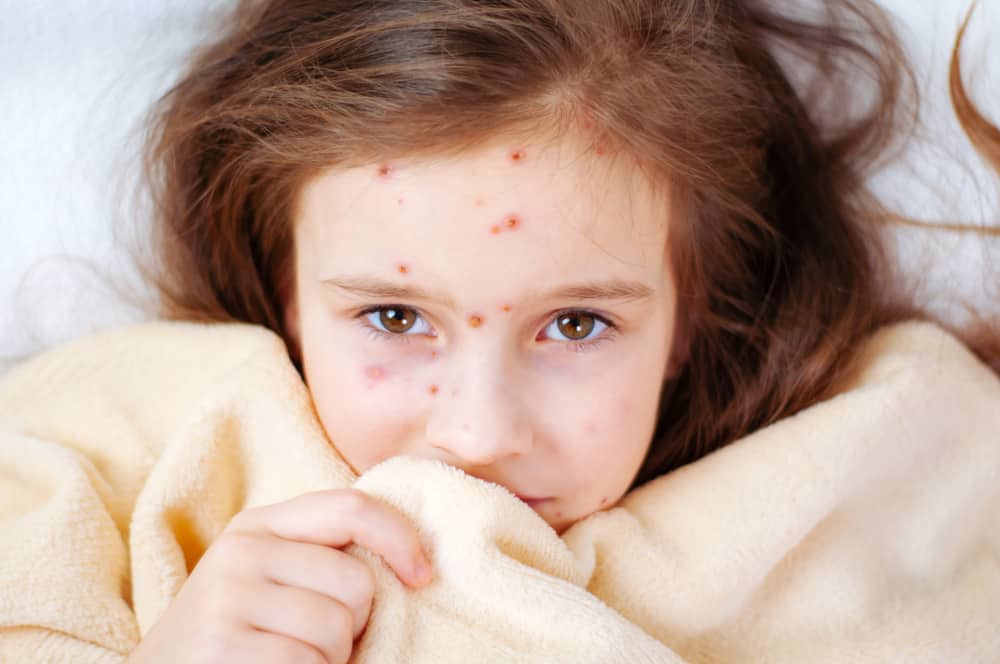 Suggerimenti per sbarazzarsi delle cicatrici della varicella che interferiscono con l'aspetto