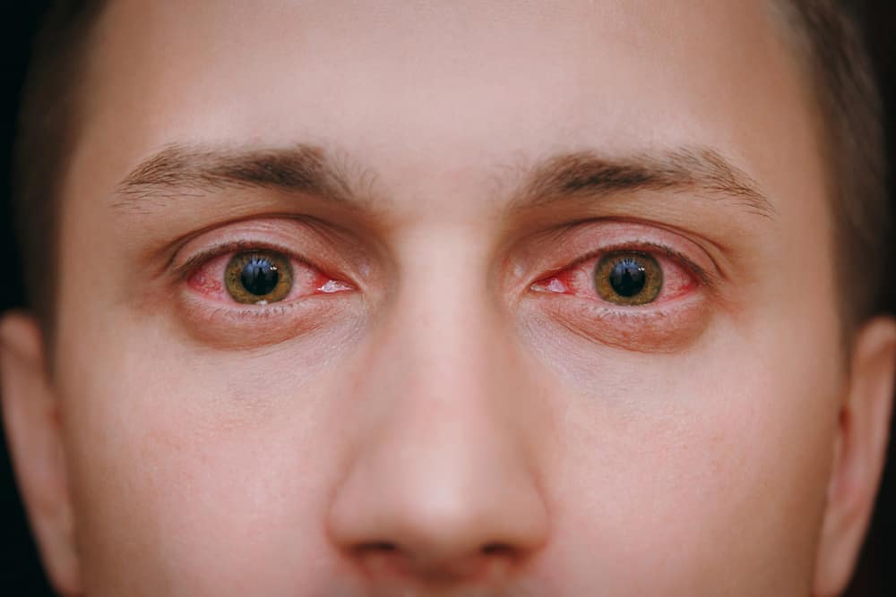 Gli occhi rossi non sono solo una questione di strabismo, sono varie cause che indicano una condizione grave