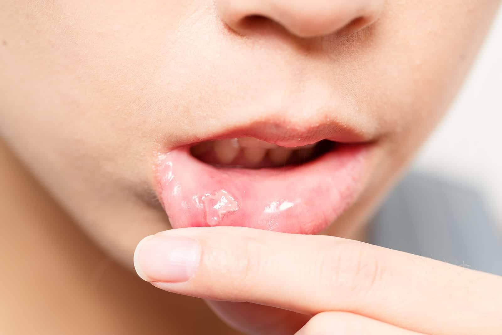 هل صحيح أن قرح الفم تنتقل عن طريق القبلة؟ ها هو التفسير!