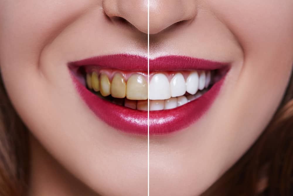 Не само, че предизвиква очарователна усмивка, какви са другите предимства на зъбните фасети?