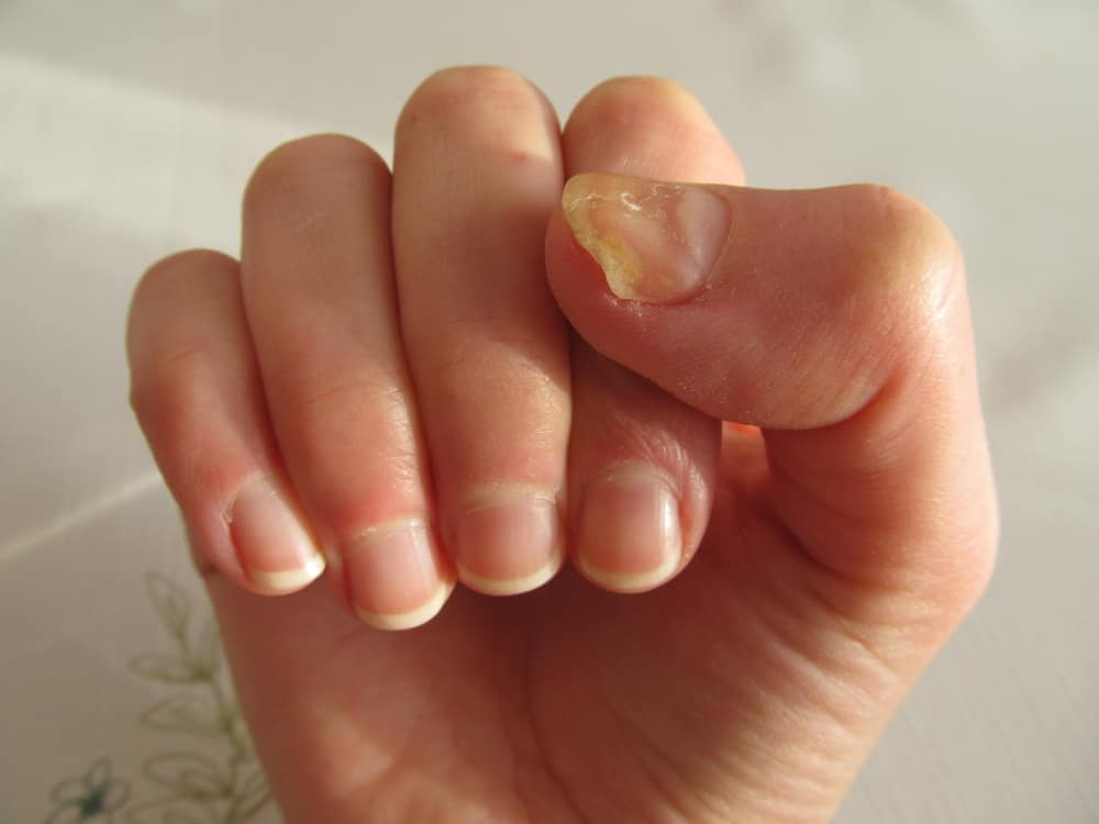 7 причини за жълти нокти, не го приемайте за даденост!