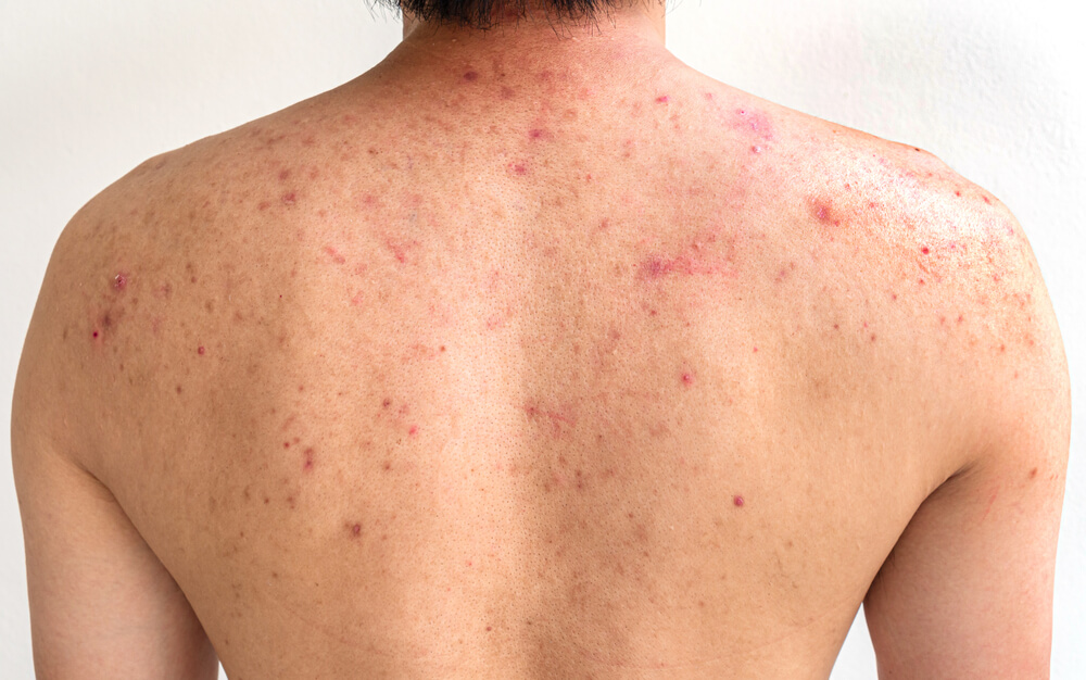 هل تعانين من البقع الحمراء على الجلد بدون حمى؟ هذه هي العوامل الأربعة التي تسبب ذلك