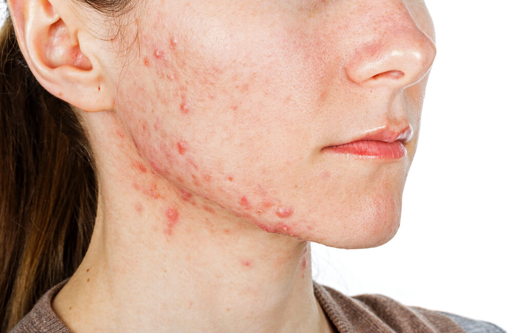 Le cicatrici del vaiolo sul viso ti rendono insicuro? Ecco i consigli per liberarsene