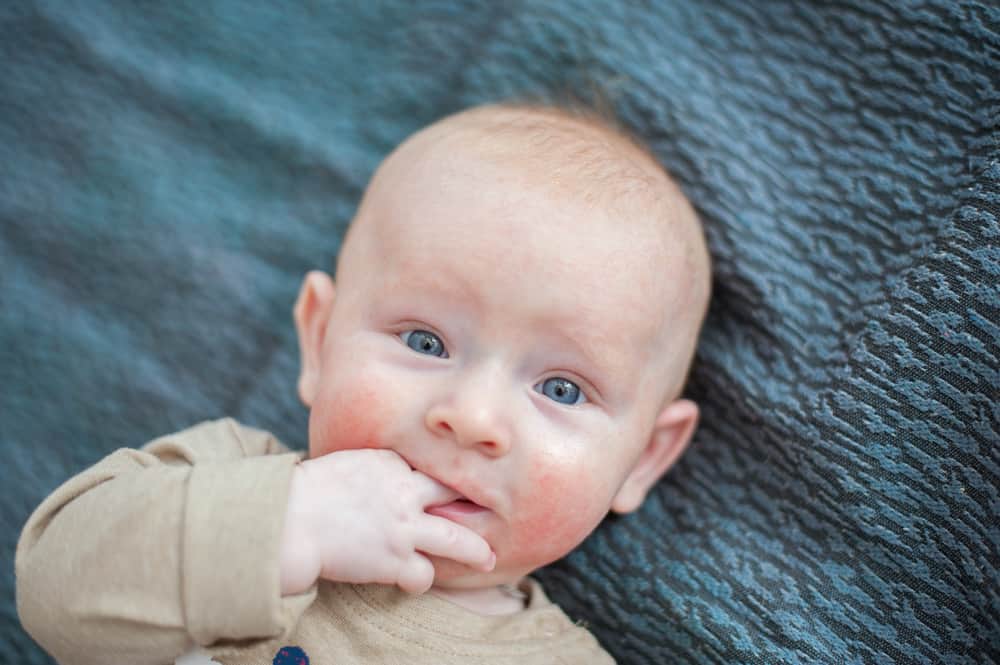 Kulit bayi anda gatal dan merah? Boleh Terkena Dermatitis