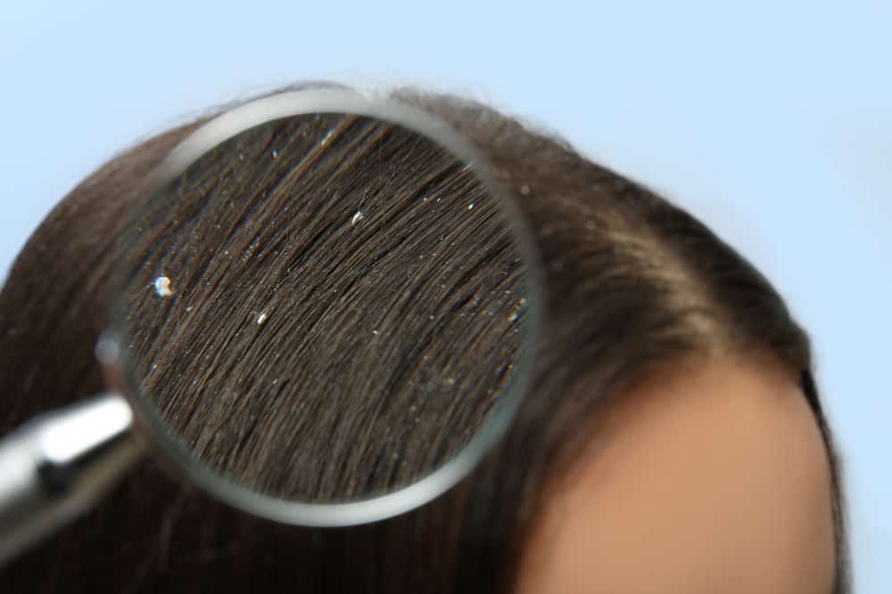 7 cause della forfora sul cuoio capelluto e come superarla