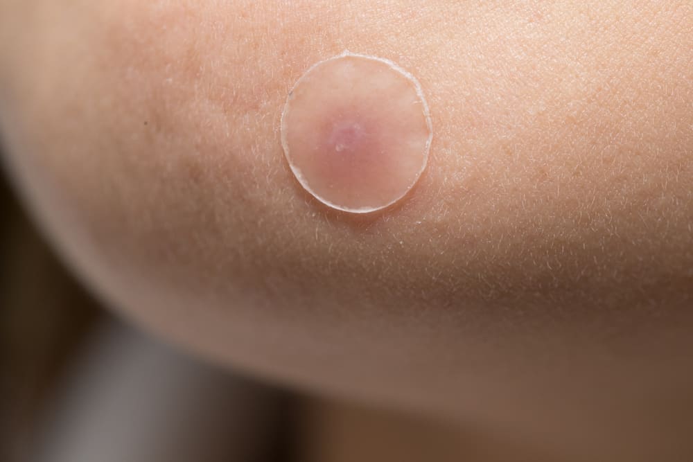 Знаейки ползите от Pimple Patch, наистина ли е ефективен при преодоляване на акнето?