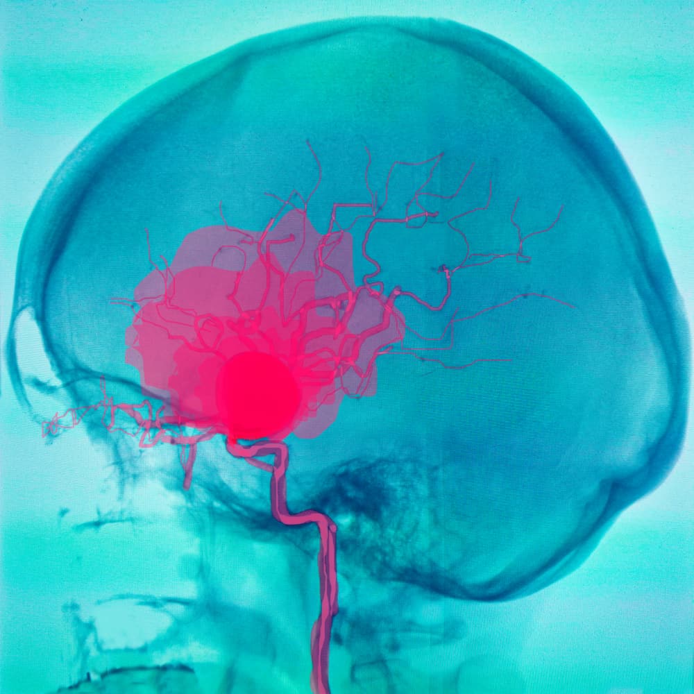 เลือดออกในสมอง: รู้จักอาการ สาเหตุ และวิธีเอาชนะมัน