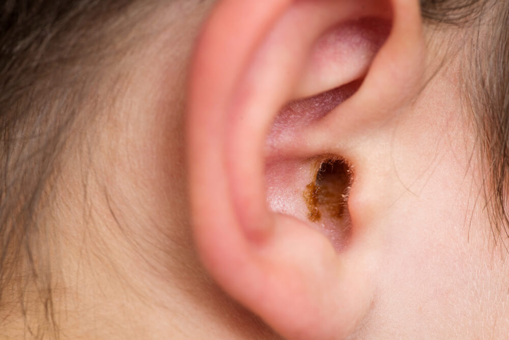 子供の耳垢が蓄積して硬化しますか？安全に掃除する方法は次のとおりです。