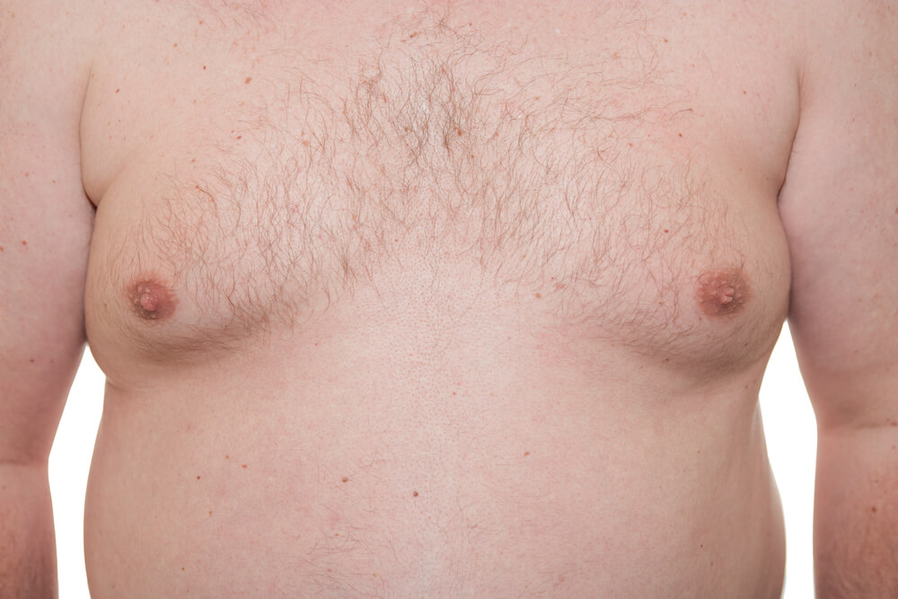 Ingrandimento del seno negli uomini: cause e come superarlo