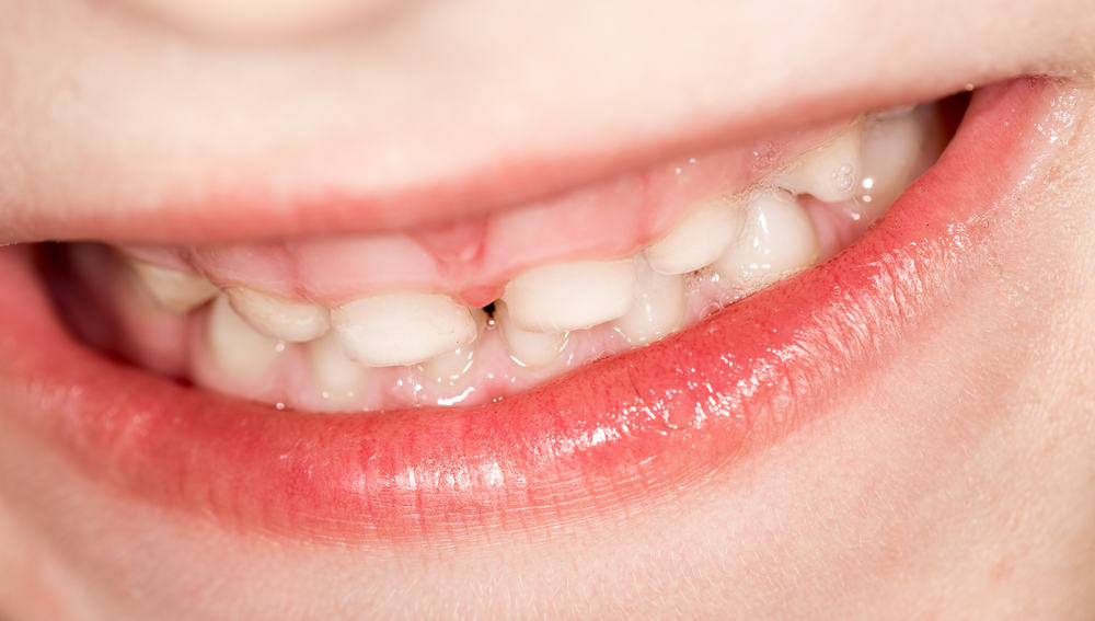 تجنب تلف الأسنان اللبنية عند الأطفال بهذه الطريقة