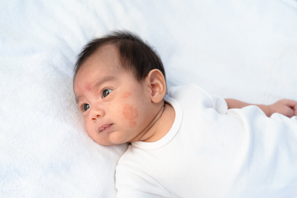 Bolehkah Bayi Alergi terhadap Susu Ibu? Inilah penjelasannya!