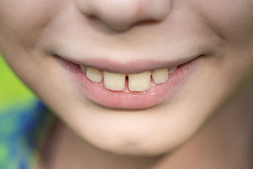 วิธีกรอฟัน Tonggos: ใช้เหล็กจัดฟันเพื่อการผ่าตัดขากรรไกร
