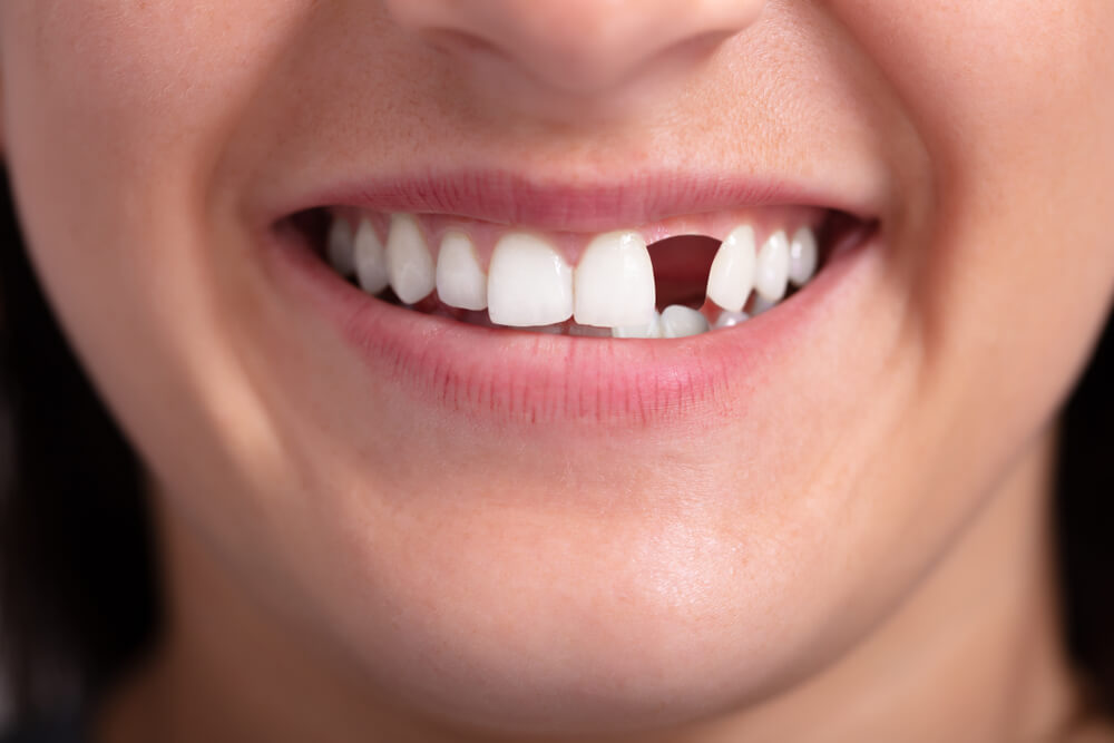 Bolehkah Gigi yang Telah Dikeluarkan sebagai Orang Dewasa Tumbuh Lagi?