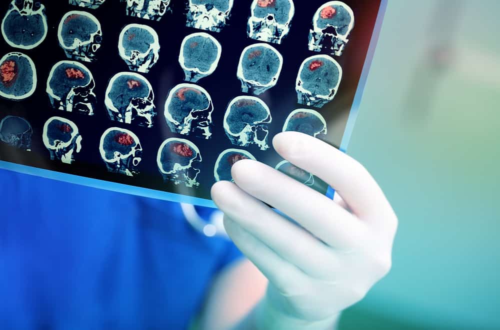 Kanser Otak: Kenali Gejala, Sebab, dan Langkah Rawatan
