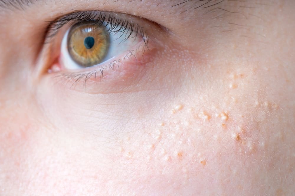 Причини за натъртване на кожата на лицето, които трябва да знаете