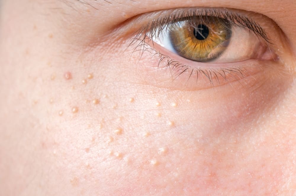 Simile all'acne, questo è il fattore che fa crescere milia vicino agli occhi!