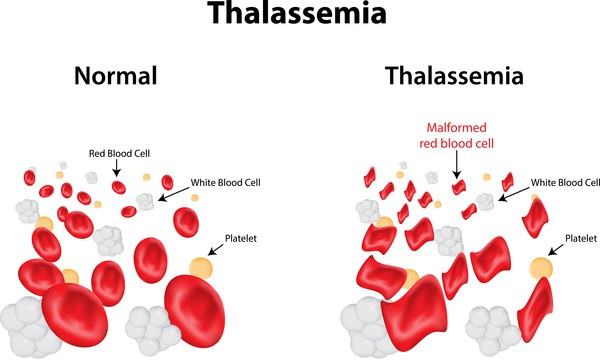 Anda boleh mengetahui status thalassaemia melalui