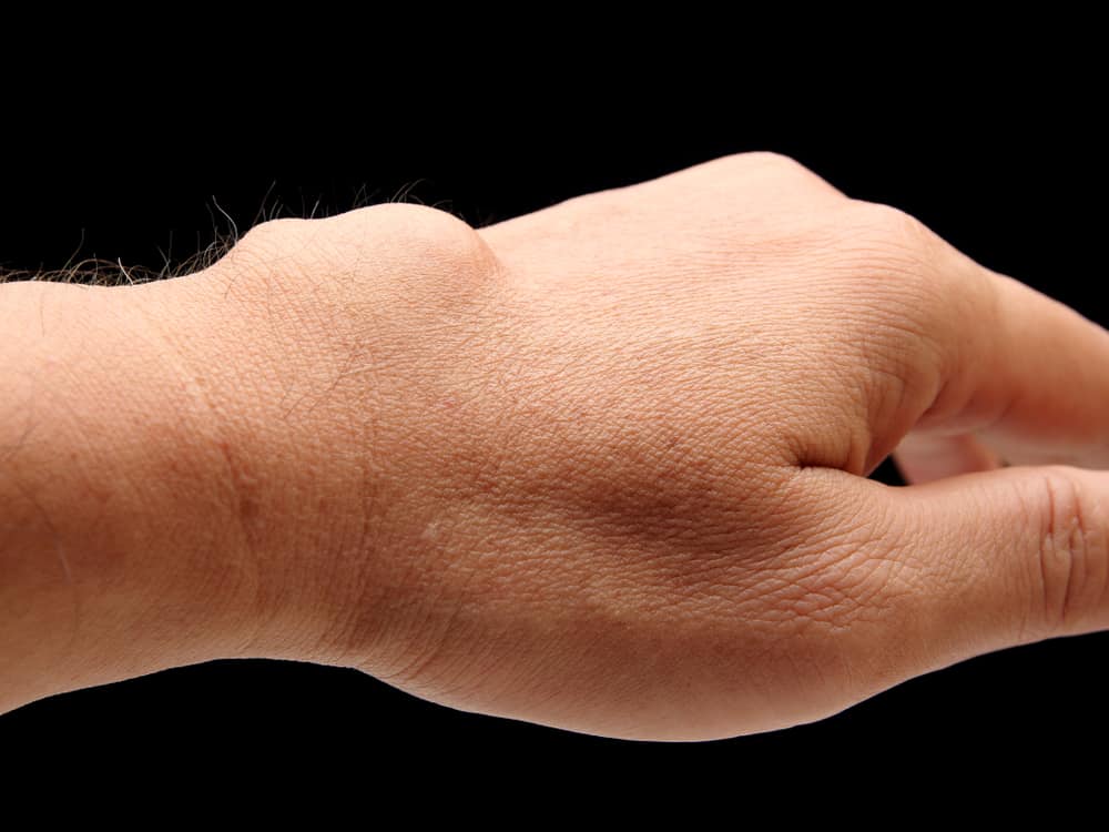 تزايد النتوءات على اليدين؟ كن حذرًا ، إنه أحد أعراض مرض الكيسات العقدية!