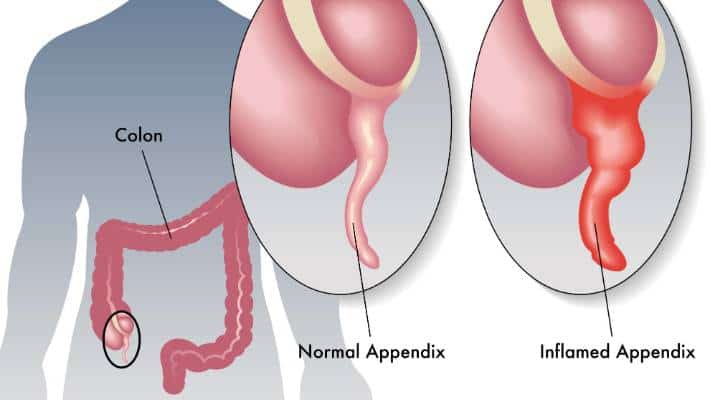 Appendix pecah punca