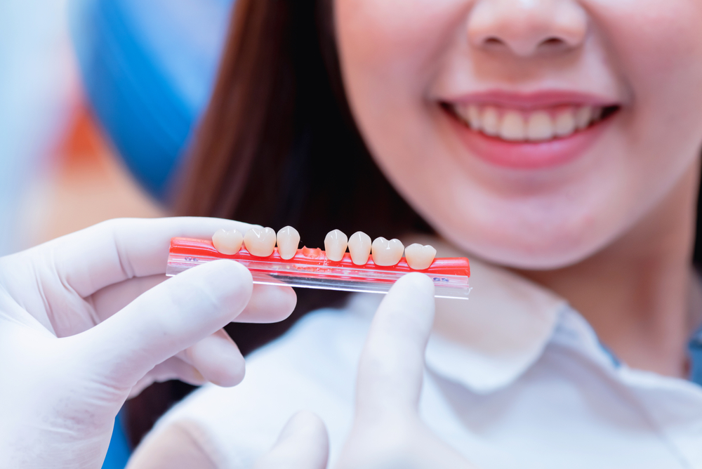 تيجان الأسنان المتنوعة: إجراءات التثبيت لنطاق التكلفة