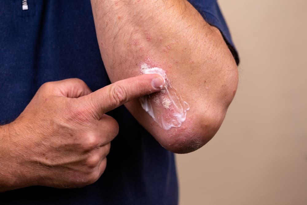 Сърбеж на кожата поради гъбички, преодоляйте със следните 8 вида мехлем
